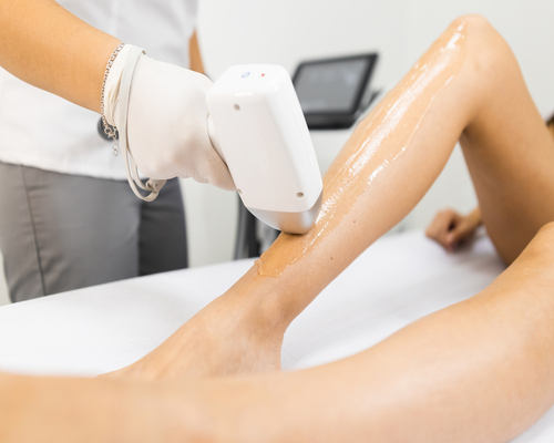Why Laser Hair Removal Is the Ideal Choice for Sensitive Skin